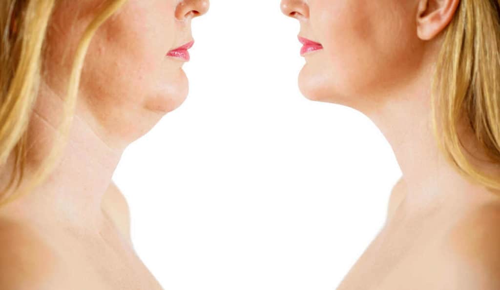 Double Chin treatment Newcastle-under-Lyme before and after results