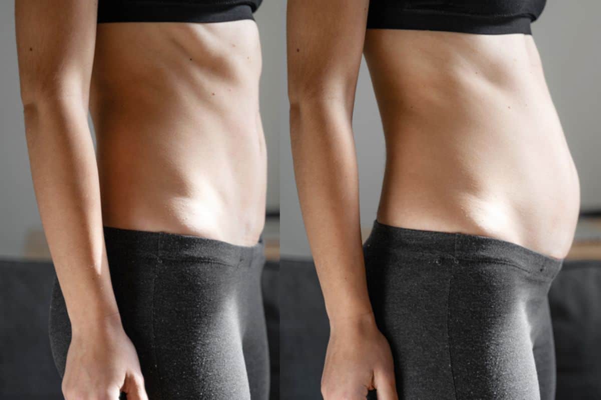 How long does diastasis recti take to improve Newcastle-under-Lyme?