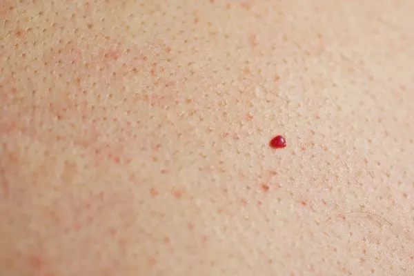 close up of a cherry angioma Newcastle-under-Lyme