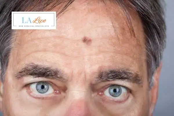 Solar Lentigo Removal Newcastle-under-Lyme image of man with mark on his forehead