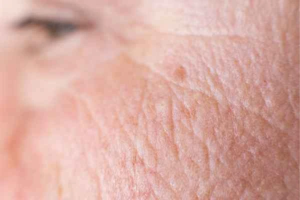 close up picture of a woman's face showing an age spot Newcastle-under-Lyme