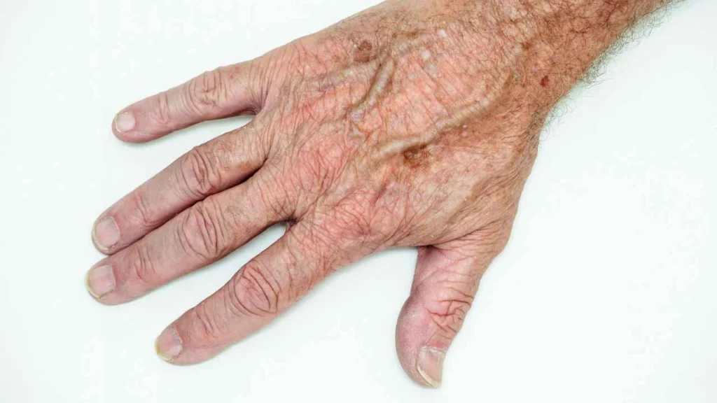 Male hand showing age spot Newcastle-under-Lyme