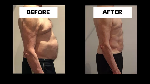 What Symptoms Can Diastasis Recti Cause in Men? Weak Core, Back Pain and Poor Posture Newcastle-under-Lyme